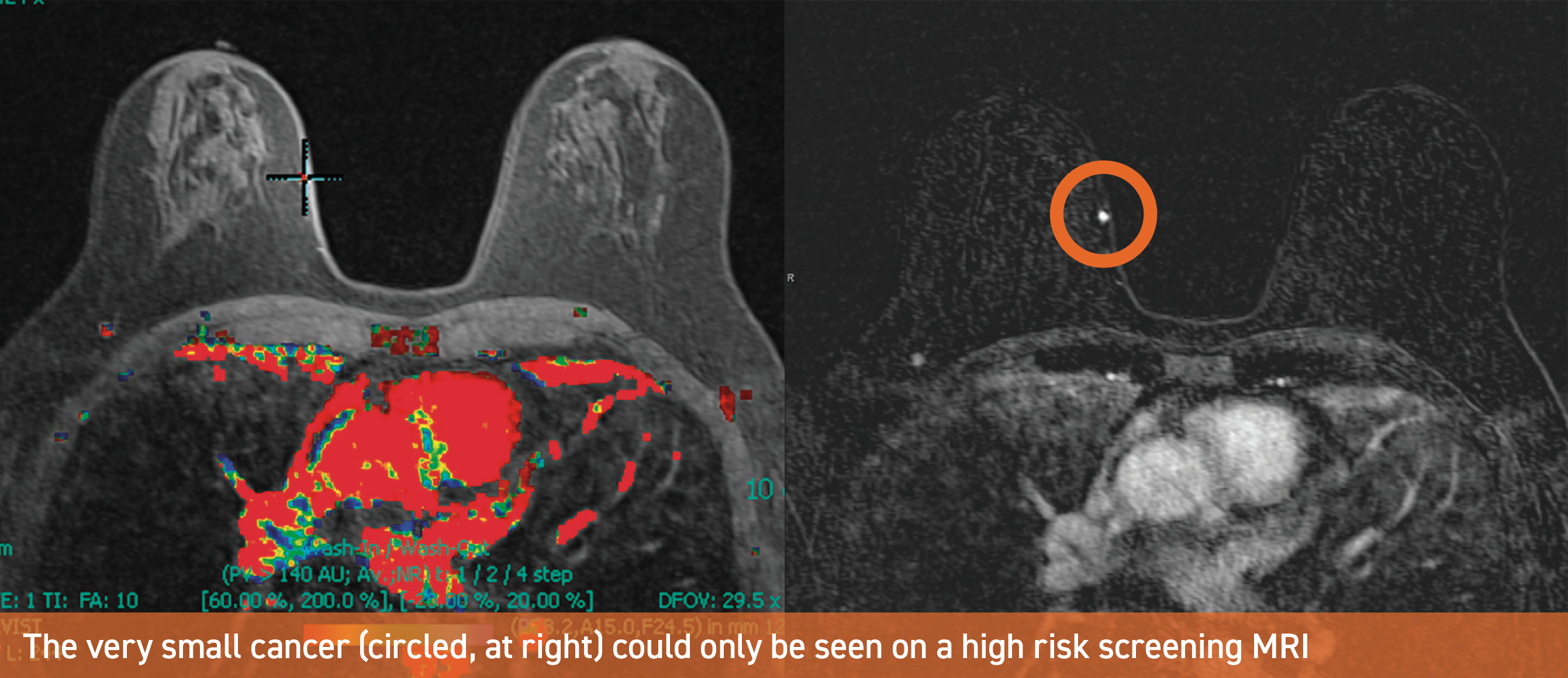 The very small cancer (circled, at right) could only be seen on a high risk screening MRI