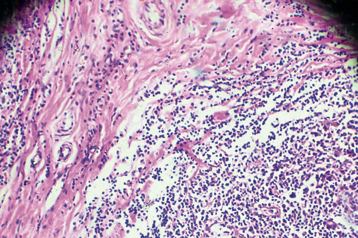 Microscopic view of Hodgkin lymphoma shows closely packed granules with a few patches and strands in-between