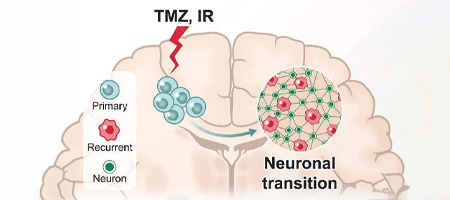 Glioblastoma tumor