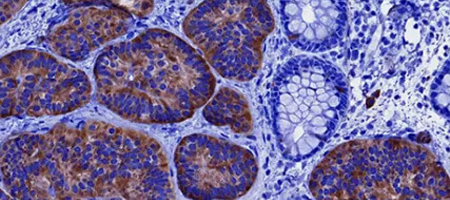 NEUROENDOCRINE TUMORS: