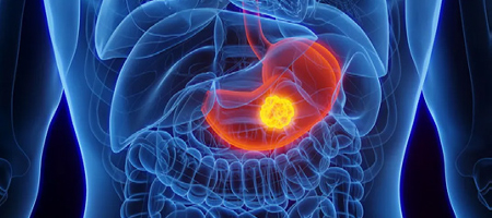Gastric Cancer