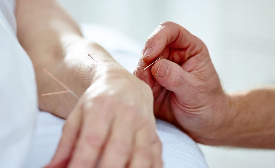 Acupuncture being applied to a woman's hand