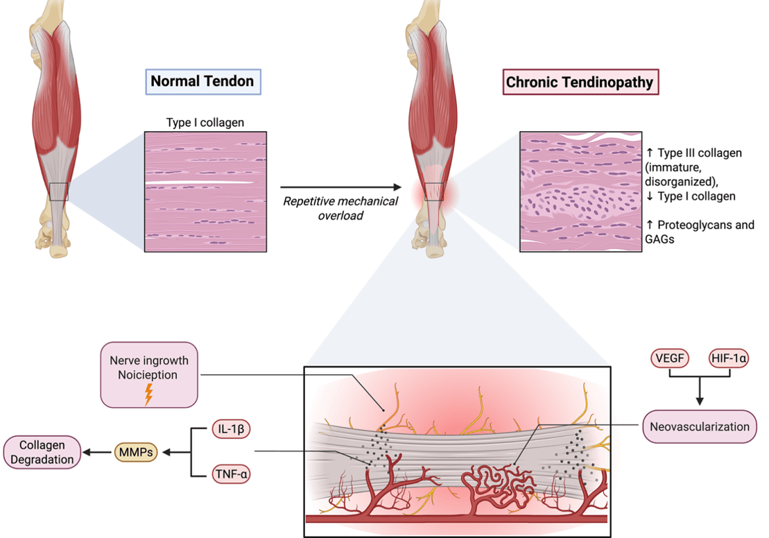 Diagram of Achilles tendinopathy pathophysiology, showing progression from normal tendon to chronic tendinopathy with collagen changes, and molecular pathway involving inflammation, neovascularization, and nerve ingrowth leading to collagen degradation