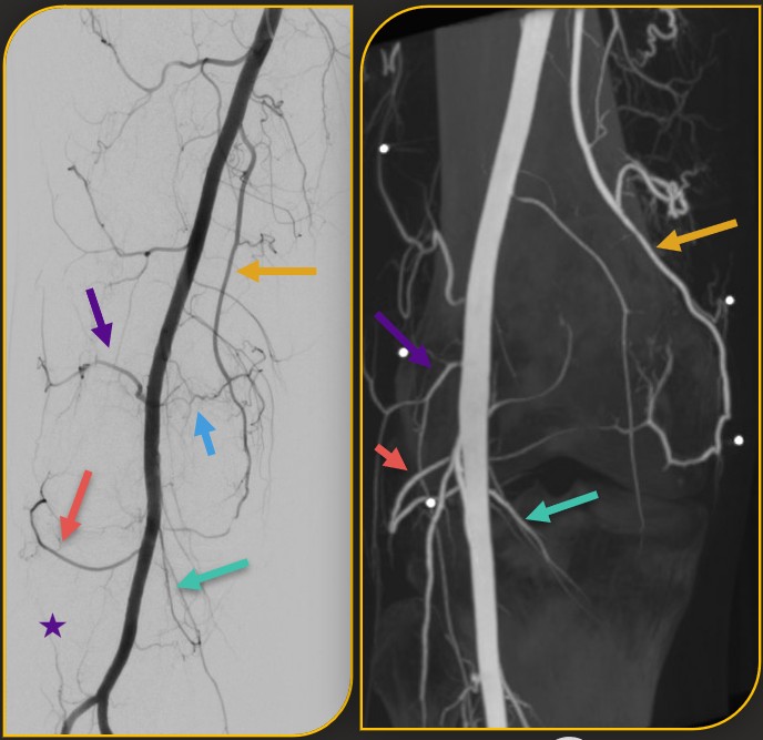Conventional and cone-beam CT angiography of the superficial femoral artery