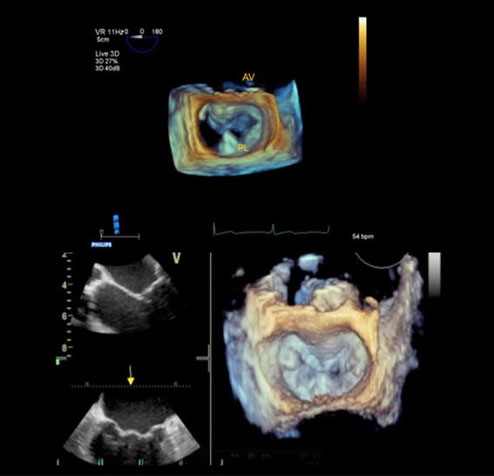 Diagram of after an endocardiogram procedure