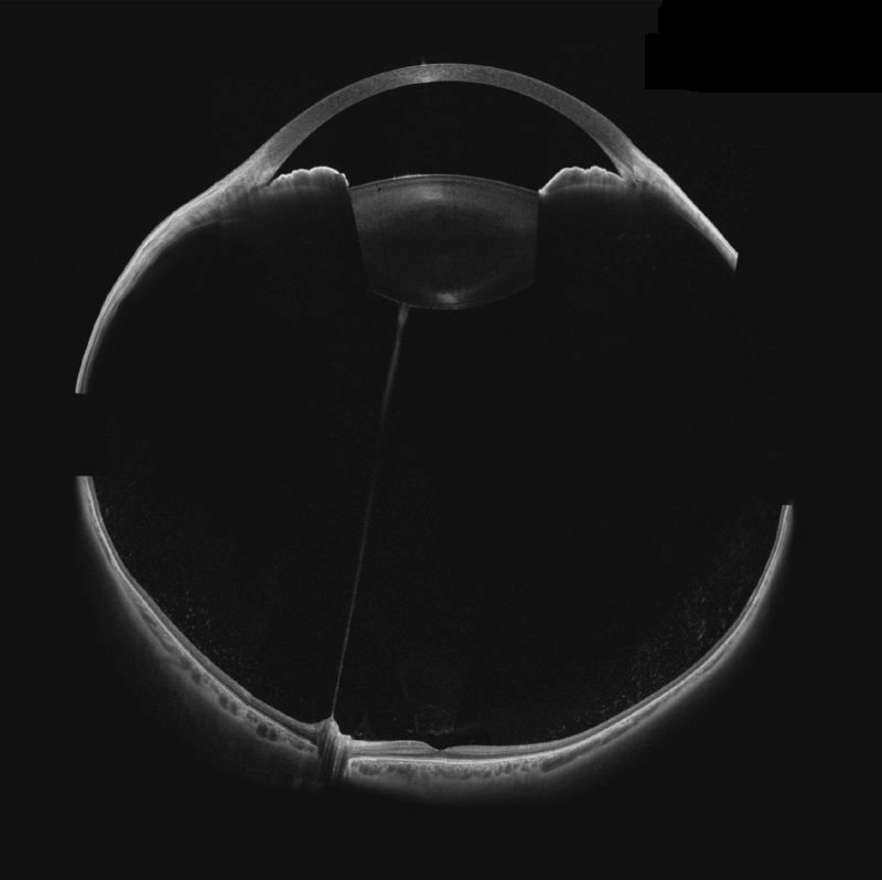 Anterior and posterior whole eye OCT image