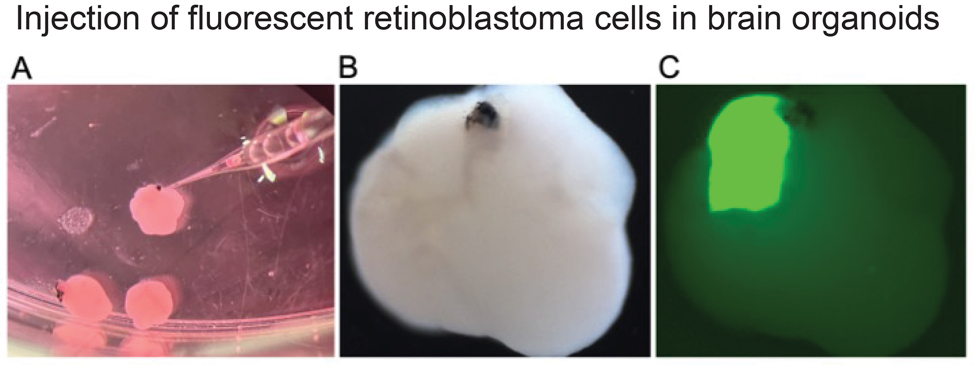 Injection of  fluorescent retinoblastoma cells in brain organoids