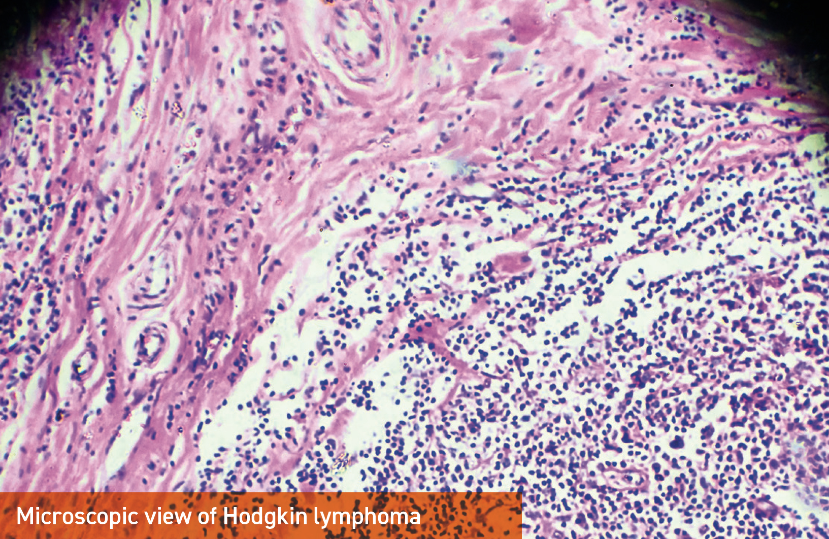 Microscopic view of Hodgkin lymphoma