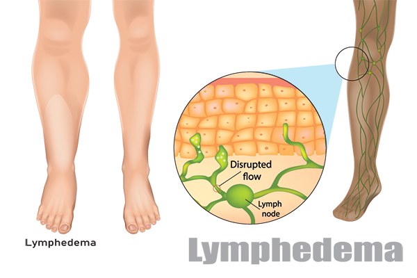 Lymphedema surgery