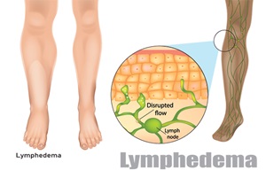 Lymphedema surgery