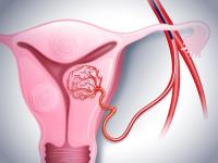 Embolización de la arteria uterina, embolización de fibroma uterino