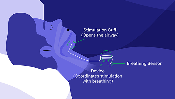 Inspire therapy fro sleep apnea airway diagram