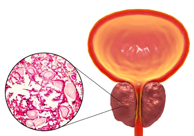 Illustration of a benign prostatic hyperplasia