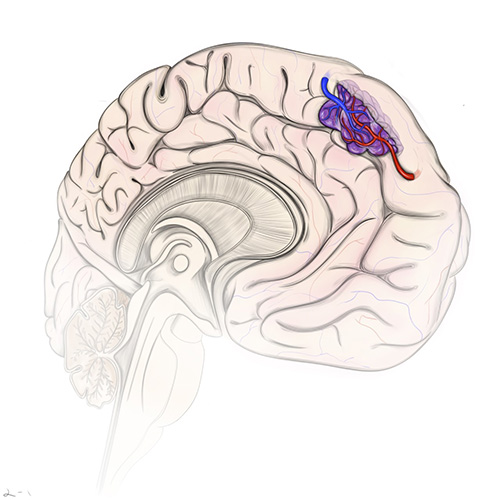 Cavernous malformations