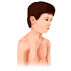 Ilustración de niño con tórax en embudo