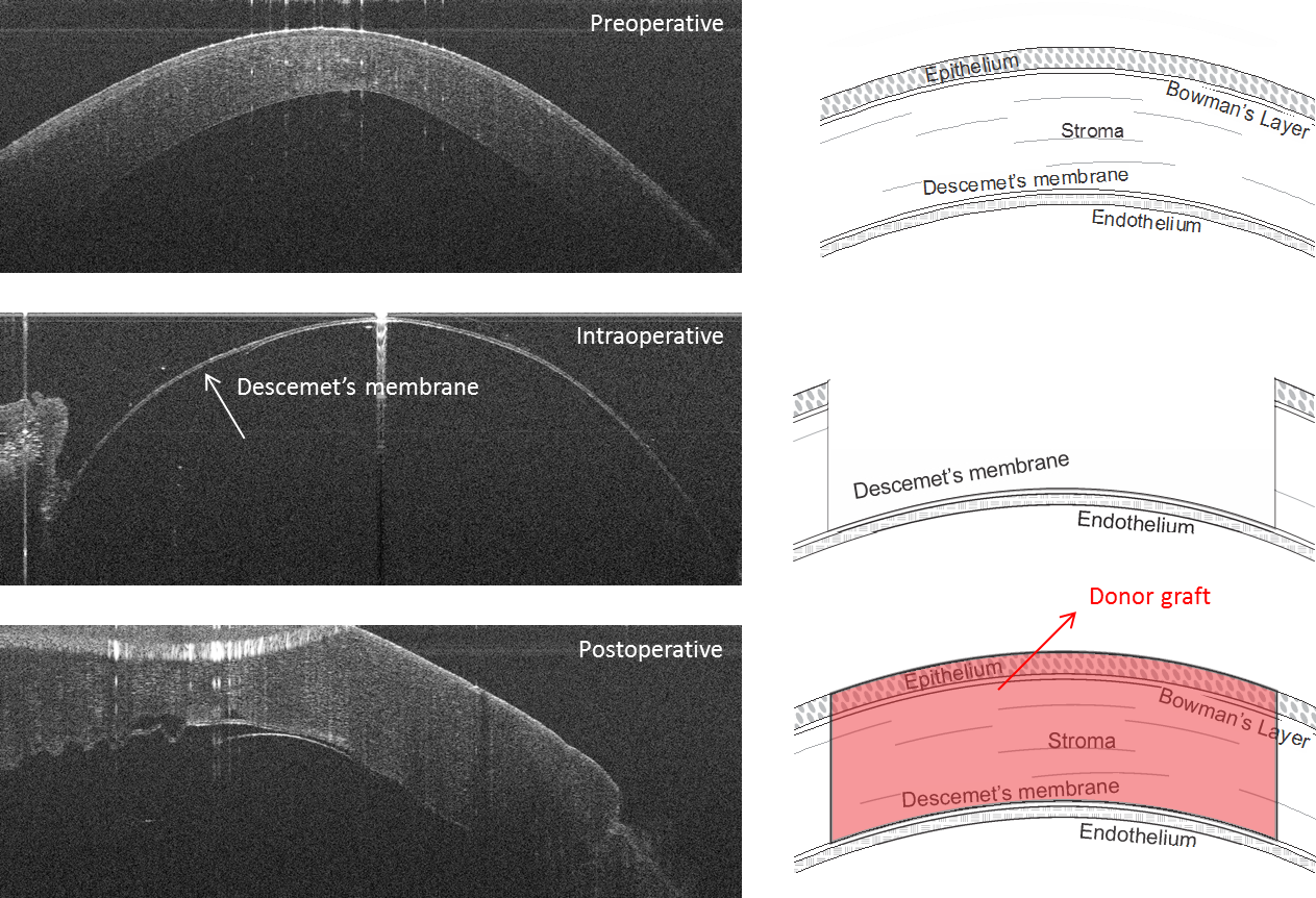 OCT guided dissection of the anterior cornea of a keratoconic eye during a DALK