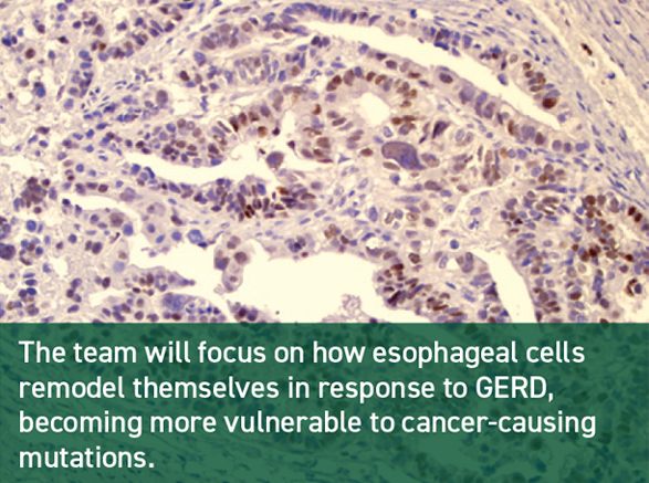 Microscopic view of Hodgkin lymphoma