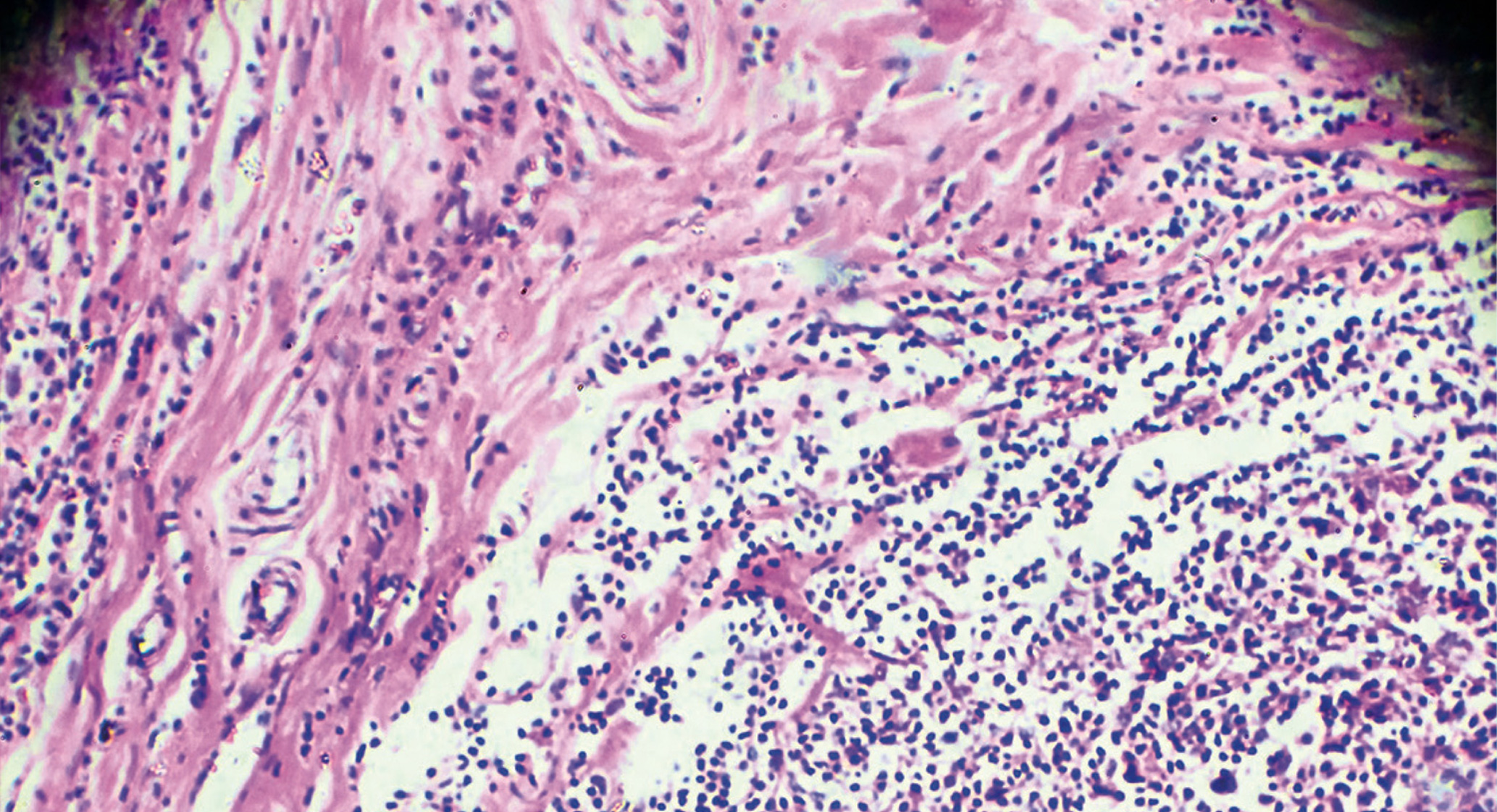 Microscopic view of Hodgkin lymphoma shows closely packed granules with a few patches and strands in-between